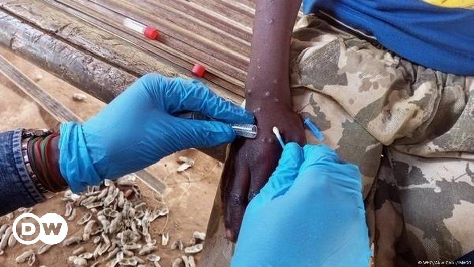 Mpox : le virus a évolué, les modes de transmission aussi