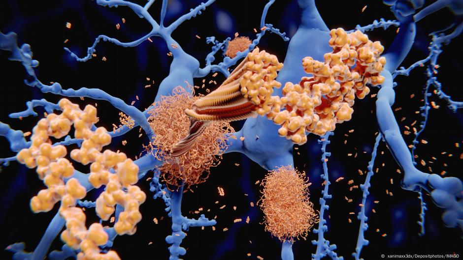 L-st-ein-weitverbreitetes-Herpesvirus-Alzheimer-aus-