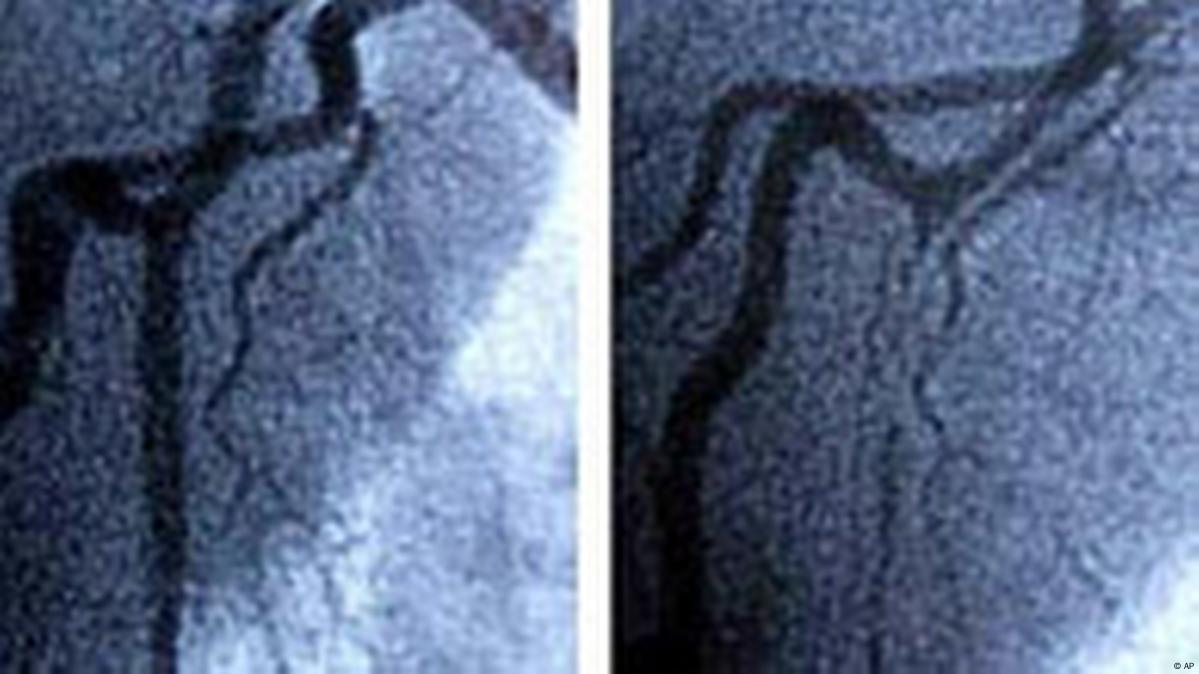 Nanotehnologija otkriva ko je sklon infarktu – DW – 31. 10. 2011.