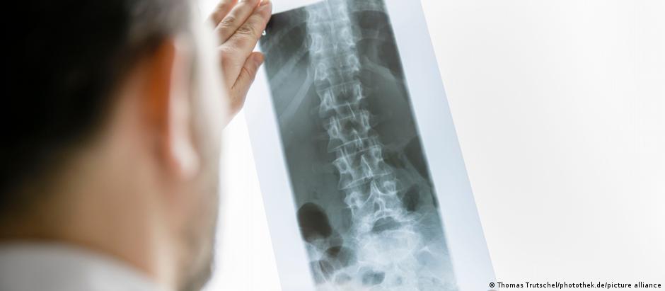 Polilaminina foi associada à recuperação de conexões nervosas na medula espinhal