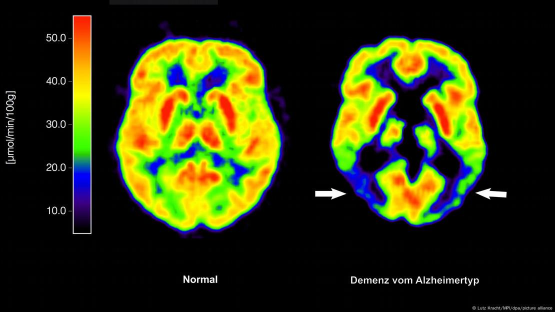 El exceso de grasas saturadas en la alimentación puede dañar el cerebro y aumentar la probabilidad de demencia.