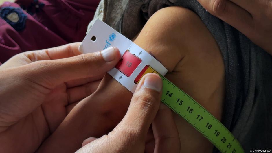 Van más de cien niños muertos por desnutrición en Gaza – DW – 10/08/2025