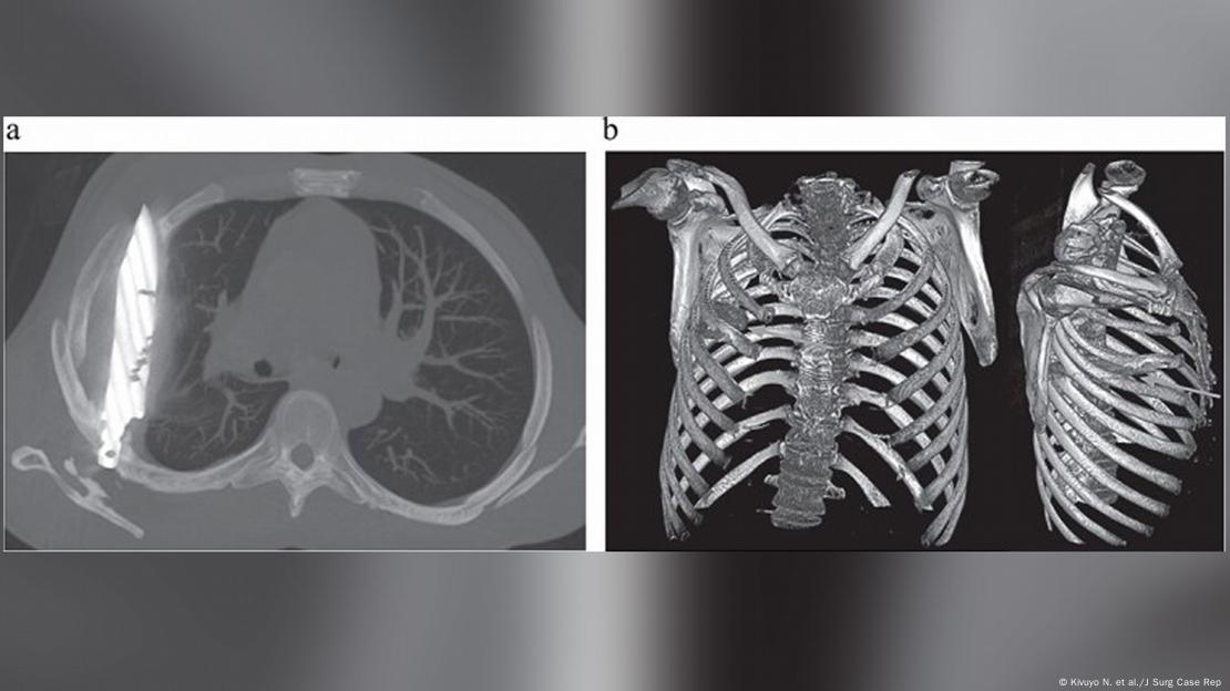 La reconstrucción 3D reveló con claridad el cuchillo retenido en el tórax derecho y las antiguas fracturas óseas asociadas tras ocho años sin detectar.