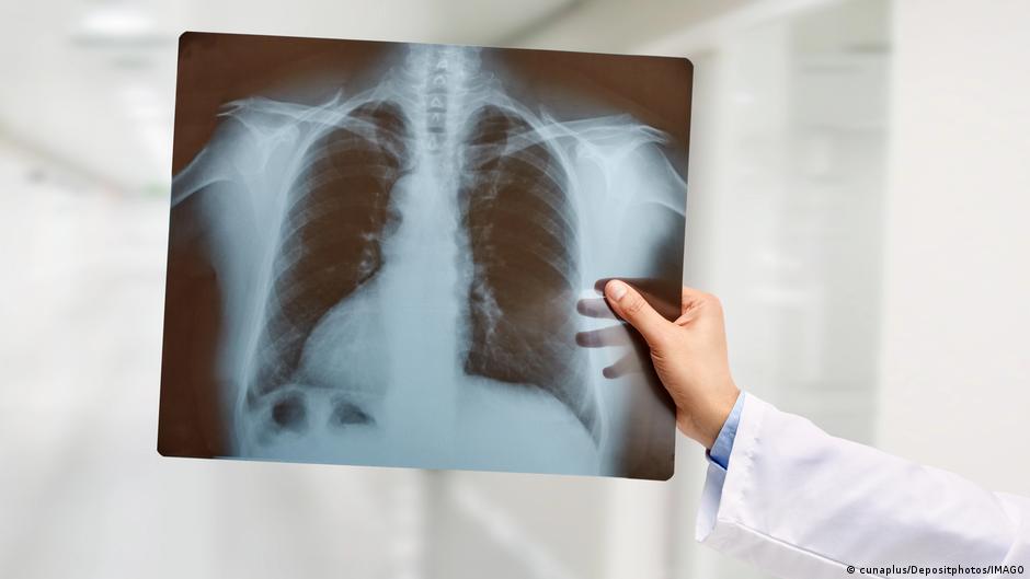 Un paciente sobrevive durante 48 horas sin pulmones