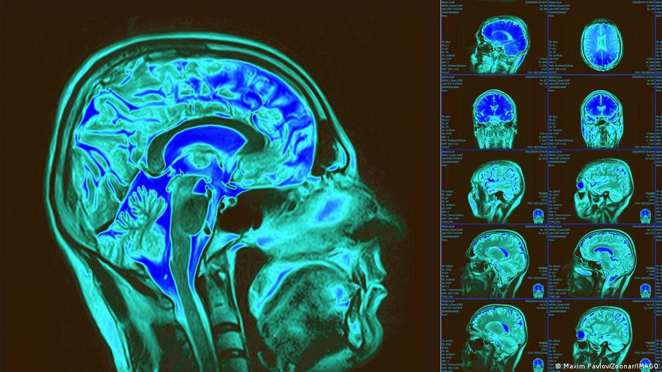 Mapa celular para entender las enfermedades cerebrales