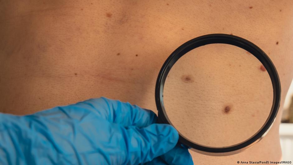 Ensayo clínico de vacuna de ARNm combinado con inmunoterapia reduce un 42 % la muerte y recaída en melanoma de alto riesgo