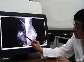Undatiertes Handout-Foto zeigt Mamographien auf einem hochaufloesendem Bildschirm. IBM baut in Grossbritannien zusammen mit zunaechst fuenf Krankenhaeusern und unterstuetzt von der britischen Regierung ein neues Computernetzwerk, ein so genanntes Grid, zur Bekaempfeung von Brustkrebs auf. Dabei werden hochaufloesende Scans von behandelten Frauen digital gespeichert und allen beteiligten Krankenhaeusern zugaenglich gemacht. (AP Photo/IBM/ho)